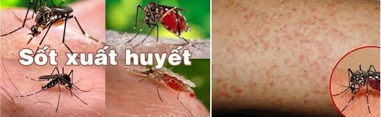 BỆNH SỐT XUẤT HUYẾT DENGUE